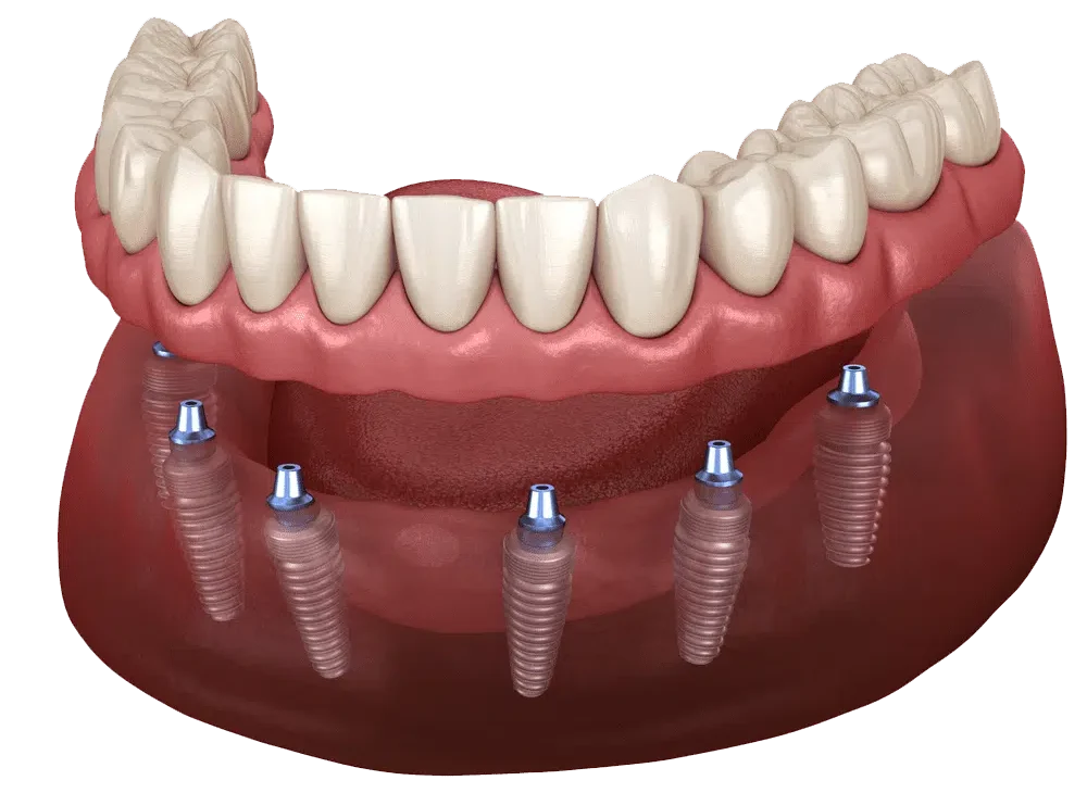 All on 6 Full Mouth Dental Implants | Dental Made Easy