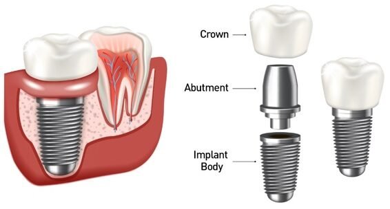 Dental implant system