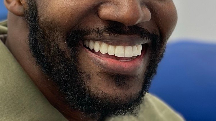 Full Mouth Implants Before Result | Dental Made Easy