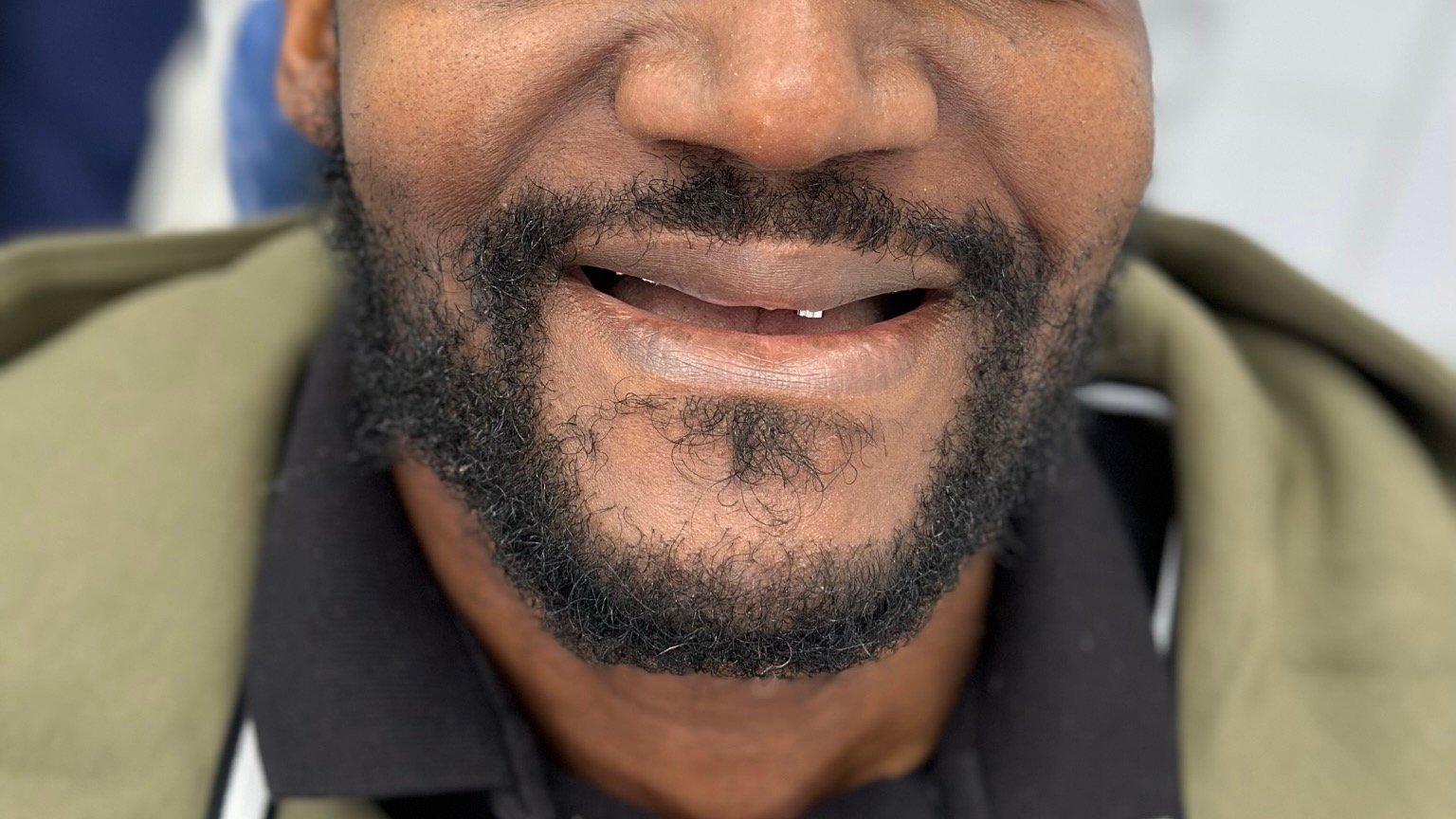 Full Mouth Implants Before | Dental Made Easy