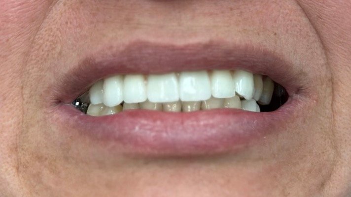 Implant Dentistry After