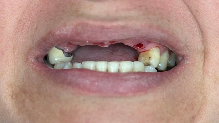 Implant Dentistry Before Implant Dentistry Before