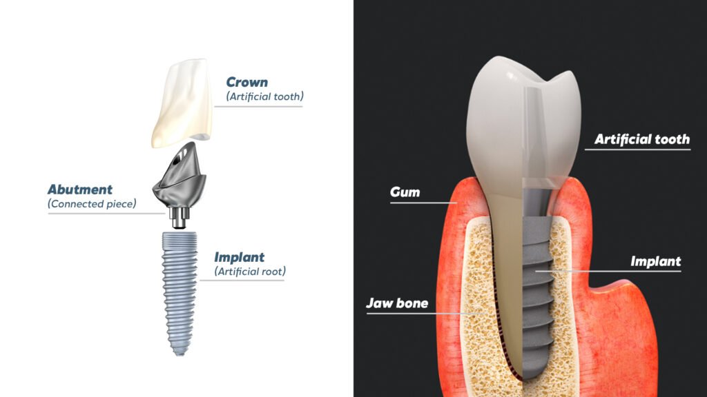 Parts of a Single Tooth Dental Implant | Dental Made Easy