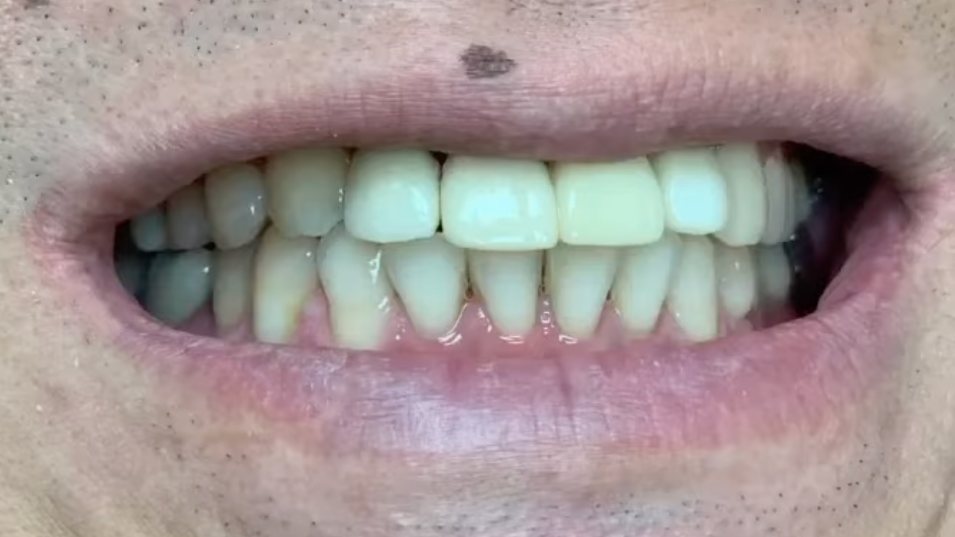 Single Tooth Implant After | Dental Made Easy