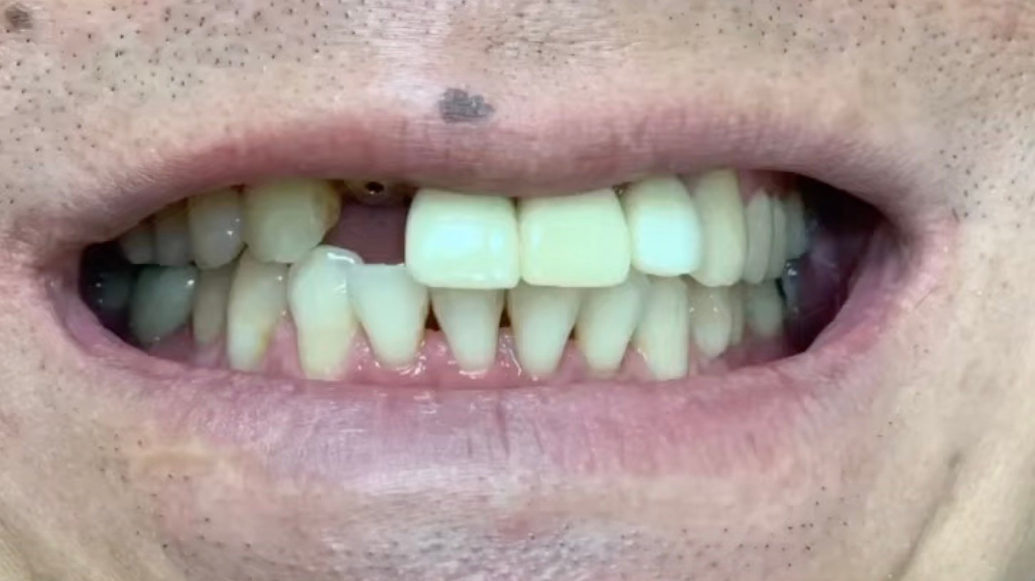 Single Tooth Implant Before Single Tooth Implant Before | Dental Made Easy