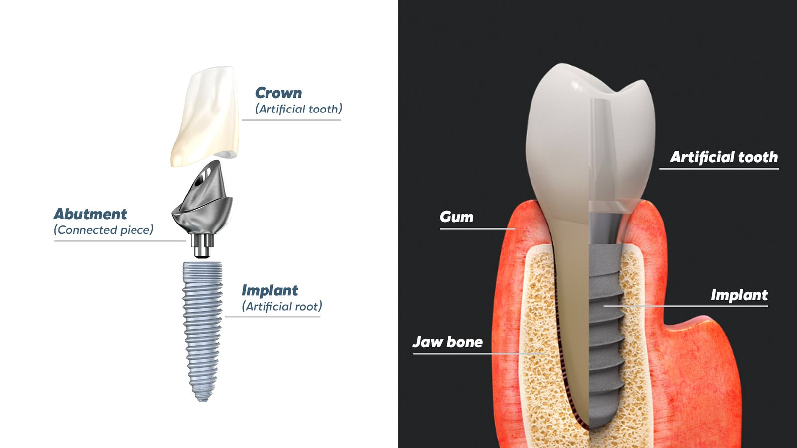 Parts of a Single Tooth Dental Implant | Dental Made Easy