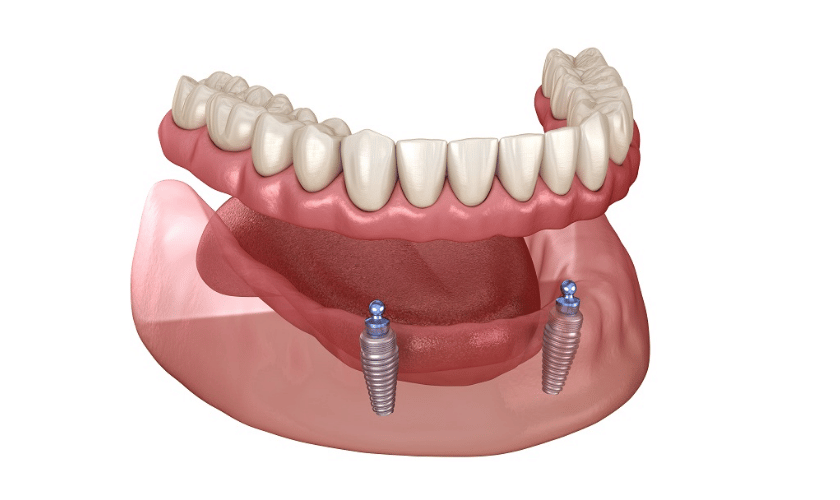 Mini Dental Implants | Dental Made Easy