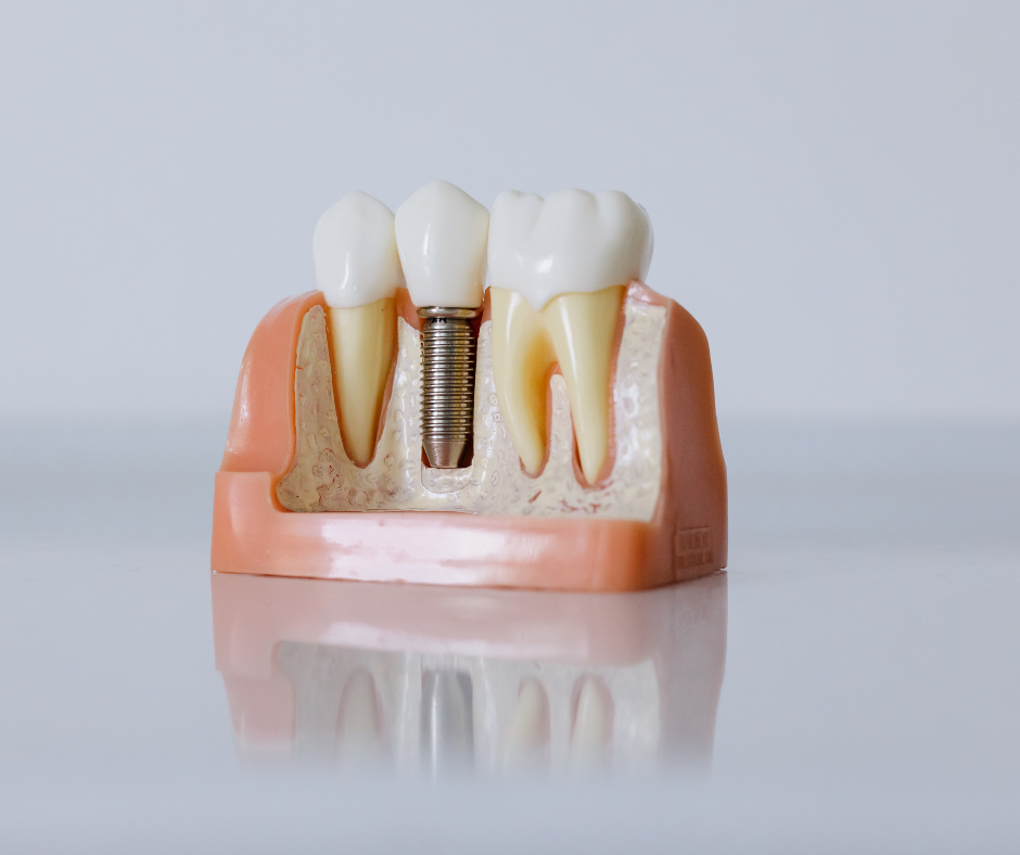 Dental Implant Service in Garden City, NY - Dental Made Easy