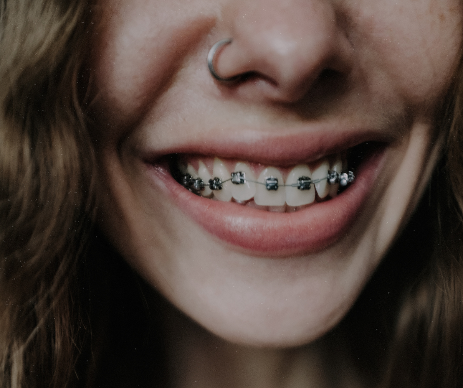 Dental braces - Dental Made Easy